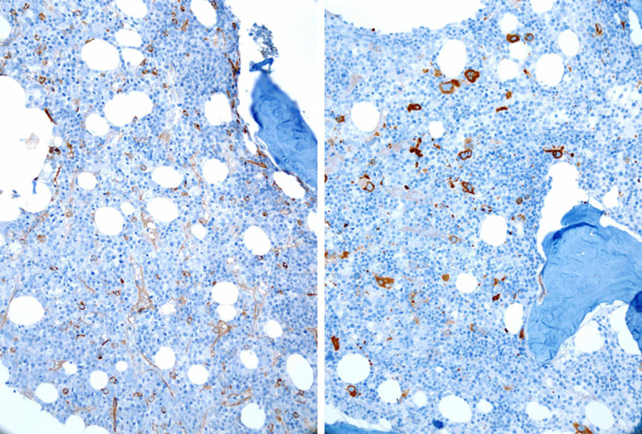 CD34 stains ~5% immature cells, CD61 highlights the atypical megakaryocytes on the core biopsy